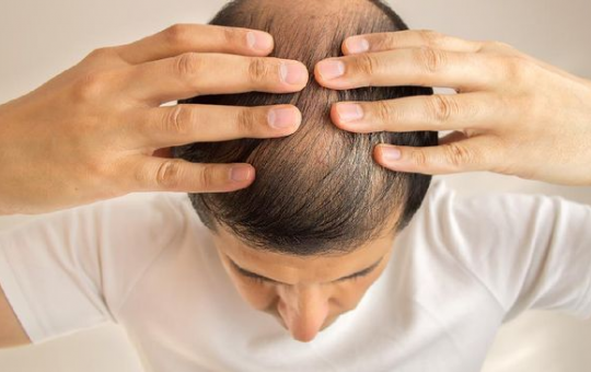 Tips Merawat Rambut Botak Agar Tetap Sehat